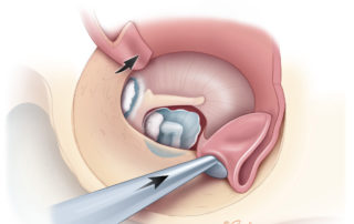 Raising the inferiorly based tympanomeatal flap.