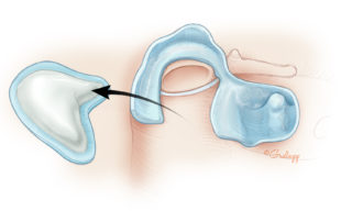 As the long process of the incus is eroded in this case, the remaining incus can be removed. If the chain was intact, it would have been necessary to cut the incudostapedial joint. With the canal wall down, this can be done with a disposable myringotomy knife which is much sharper than an incudostapedial joint knife used in stapes surgery when the stapes is fixed. Severance of the joint with a sharp knife is preferable when the stapes is mobile.