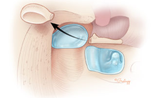 Removal of the malleus head leaving the umbo in the tympanic membrane remnant. See section 8.11 Ossicles in Cholesteatoma for technique of removal of the matrix from the stapes.