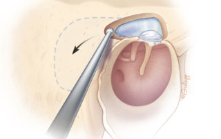 Retrograde mastoidectomy; the so-called inside-out approach.