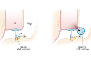 Two varieties of cholesteatoma recidivism: residual and recurrent forms. In residual, a fragment of squamous epithelium was left during surgery. In recurrent, a new pouch forms de novo. EAC, external auditory canal.