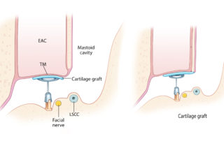 Cartilage placed leaving a space at the scutum (left) and abutting the scutum (right). Close approximation of the cartilage with the ear canal edge is preferred to discourage cholesteatoma recurrence. EAC, external auditory canal; TM, tympanic membrane; LSCC, lateral semicircular canal.