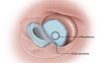 Two pieces of cartilage to both reinforce the tympanic membrane and repair a scutal defect.