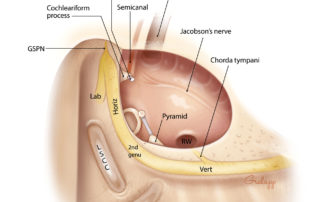 Anatomical detail of the course of the facial nerve on the medial wall of the middle ear and floor of the mastoid. Understanding this anatomy is key to safe and effective ear microsurgery. Note the intimate relationship of the stapes and oval window to the horizontal (tympanic) segment of the nerve. The lateral semicircular canal parallels the facial nerve’s horizontal segment. Anteriorly in the middle ear, the cochleariform process lies immediately inferior to the nerve. These landmarks are important in the identification of the nerve when the anatomy is obscured by disease. Lab, labyrinthine segment; Vert, vertical (mastoid) segment; GSPN, greater superficial petrosal nerve; RW, round window; LSCC, lateral semicircular canal; PSCC, posterior semicircular canal.