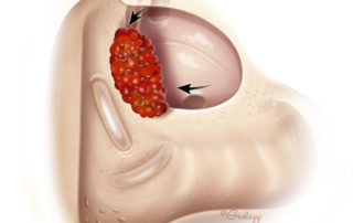 Achieving orientation to the facial nerve by approaching the oval window from inferior to superior and the cochleariform process from anteriorly.