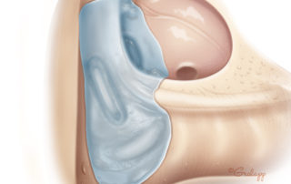 Typical appearance of cholesteatoma matrix on the stapes footplate, facial nerve, and lateral and posterior semicircular canals.