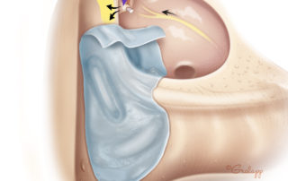 When the oval window area is obscured by disease, the tympanic segment of the facial nerve can be identified by following the tympanic plexus (black arrow) to the cochleariform process (purple arrow) which hangs from the anterior tympanic segment of the nerve. The Eustachian tube orifice is a helpful landmark in locating the cochleariform process (green arrow).