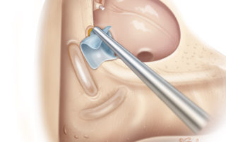 Removal of the cholesteatoma matrix from the facial nerve with an intact fallopian canal.