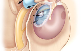 Posterior mesotympanic cholesteatoma illustrating the pathways to the mastoid and middle ear. The three arrows in the posterior middle ear illustrate penetration of the facial recess and sinus tympani. (Used with permission from Jackler RK. The surgical anatomy of cholesteatoma. Otolaryngol Clin NA 1989;22:883–896.)