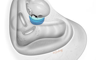 The sinus tympani is of variable depth; it may be shallow or extend posterior to the facial nerve. Note that the recess spans roughly from the oval to the round window.