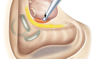Removing the bone from the posterior annular groove and pyramid (origin of the stapedius muscle) can shallow the sinus tympani and improve access for disease removal.