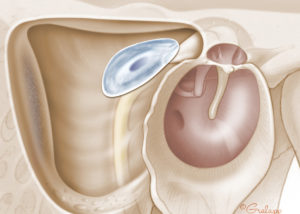 Cholesteatoma matrix on a lateral semicircular canal fistula. Management options include resection of the matrix or exteriorization via canal wall down procedure.