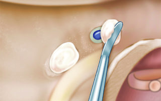 A transected semicircular canal should be sealed. Illustration depicts bone wax plugging. Should the lumen be entered, it is important to avoid use of potentially ototoxic ear drops on the packing.