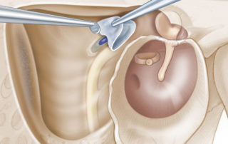 Removing cholesteatoma matrix on a lateral semicircular canal fistula. If the overlying matrix is not inflamed, then usually it can be removed from the intact semicircular canal endosteum with gentle dissection.