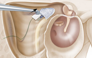 Removing cholesteatoma matrix on a lateral semicircular canal fistula with a cottonoid patty.