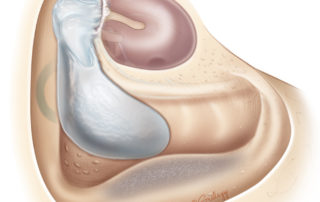 Bondy type of modified radical mastoidectomy exteriorizes the matrix-covered ossicular chain. This is a suitable option when the hearing is good and the middle ear is free of disease.
