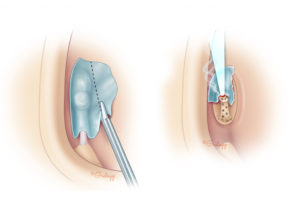 Microsurgical trimming cholesteatoma matrix followed by laser vaporization of the portion adherent to the stapes superstructure. Use of the laser minimizes vibratory trauma to the inner ear. Due to the proximity of the facial nerve, periodic irrigation is important to reduce thermal impact which could injure the nerve.