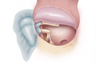 Cholesteatoma encasing the malleus head and incus body with an intact ossicular chain. Ears with this pattern of disease often have good hearing.