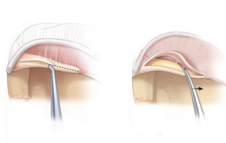 Elevation of the tympanic membrane from the malleus. The membrane adheres at the short process and the tip of the umbo. These attachments need to be severed sharply.