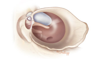 Congenital cholesteatoma sometimes penetrates the anterior epitympanum.