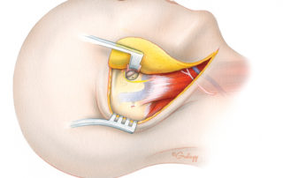 Lateral overview of the facial nerve in the mastoid. Note how the facial nerve crosses lateral to the jugular bulb en route to the stylomastoid foramen.