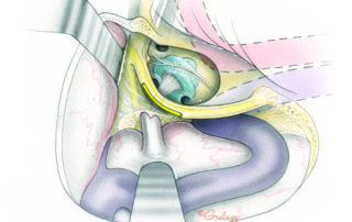 The proximal course of the facial nerve in the temporal bone. Lateral dissection exposing the transparent floor of the middle ear and the internal auditory canal illustrating the proximal course of the nerve between the geniculate ganglion and the internal auditory canal. Note that the semicircular canals have been removed.