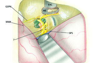 The relationships of the facial nerve as seen from above via the middle fossa approach. Note the intimate relationship of the labyrinthine and upper tympanic sections to the cochlea. The external auditory canal (EAC), middle ear (ME), cochlea (Co), and superior semicircular canal (SSCC) normally lie beneath bone but are made visible as an aid to orientation. GG, geniculate ganglion; GSPN, greater superficial petrosal nerve; 7, facial nerve; SVN, superior vestibular nerve; SPS, superior petrosal sinus; MMA, middle meningeal artery.