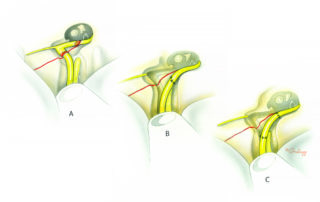 Transection injury to the geniculate ganglion in transverse temporal bone fracture (A) can sometimes be repaired directly by rerouting the nerve across the base of the geniculate triangle (B). This has the advantage of a single anastomosis. In more extensive injury, an interposition nerve graft is needed (C).