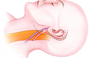 To expose the greater auricular nerve, a postauricular incision is carried inferiorly into the upper neck. The incision can usually be placed in a natural skin crease, thus creating only a subtle scar.