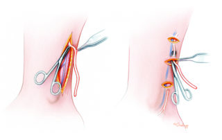The sural nerve can be harvested either through a longitudinal incision or a series of short stair-stepped transverse incisions.