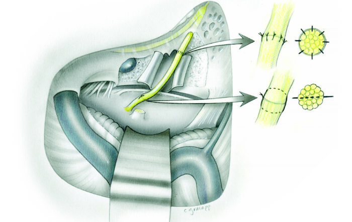 Repair of the Facial Nerve – Oto Surgery Atlas