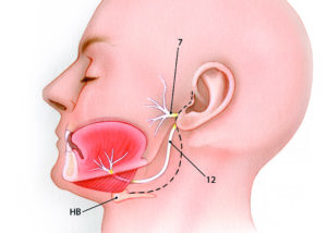 Hypoglossal–facial anastomosis is performed through a preauricular incision (dashed line) which is carried into the upper neck approximately 2 cm beneath the mandible. 7, facial nerve; 12, hypoglossal nerve; HB, hyoid bone.