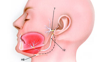 Hypoglossal–facial anastomosis is performed through a preauricular incision (dashed line) which is carried into the upper neck approximately 2 cm beneath the mandible. 7, facial nerve; 12, hypoglossal nerve; HB, hyoid bone.
