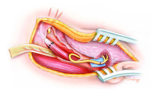 The nerves are then anastomosed over a microsurgical background consisting of a colored piece of plastic sheet. Prior to anastomosis, the cut ends of the nerves are examined microscopically and freshened with sharp microscissors as required. Approximately six interrupted epineurial sutures are used.