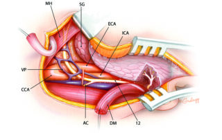 In this surgical view, the contents of the submandibular triangle and upper neck have been rendered visible to demonstrate their relation to the hypoglossal nerve. Note the interconnecting network of veins typically parallel and cross over the hypoglossal nerve. As it enters the tongue, deep to the mylohyoid muscle, the hypoglossal nerve divides into its terminal branches. CCA, common carotid artery; VP, venous plexus of the submandibular triangle; A, ansa cervicalis; ECA, external carotid artery; DM, digastric muscle; 12, hypoglossal nerve; MH, mylohyoid muscle; SG, submandibular gland; ICA, internal carotid artery.