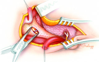 The fascia of the submandibular triangle is opened deep to the course of the posterior belly of the digastric muscle. The tissues are dissected in a direction parallel to the course of the hypoglossal nerve. The veins which lie adjacent to the nerve often must be ligated.