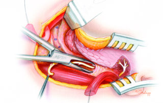 The hypoglossal nerve is then dissected in the retrograde direction toward its exit from the cranial base. The ansa cervicalis is divided as is the small artery which usually crosses the nerve just superior to this point. In order to obtain a favorable angle of rotation for tension-free anastomosis, the nerve must be mobilized fairly high in the neck. It is helpful to leave small tags of connective tissue on the nerve, as depicted here, to serve as handles while manipulating the nerve.