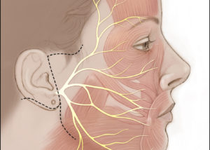 The anatomy of the facial nerve is shown as it travels toward target muscles in the face. Also shown are typical facial incisions for combined hypoglossal-to-facial nerve and masseteric-to-facial nerve transfer procedures for facial reanimation in cases of chronic facial paralysis.