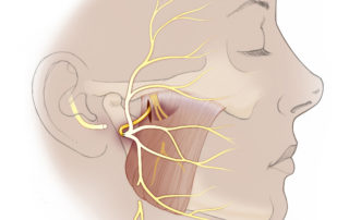 Masseteric nerve transfer: the masseteric nerve courses through the sigmoid notch and into the fibers of the masseter muscle. It may be cut at its distal extent, and used as a source of nerve input for a chronically paralyzed facial nerve. The facial nerve may be cut near the stylomastoid foramen, and transposed to the nerve to masseter for coaptation.