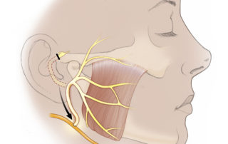 Another alternative is to perform end-to-side facial hypoglossal anastomosis by mobilizing the facial nerve from the second genu (solid line). It is transected and freed from soft-tissue attachments near the stylomastoid foramen, then transposed toward the hypoglossal nerve. Approximately 50% of the hypoglossal nerve is spared in a partial neurotomy, thereby preventing hemiatrophy of the tongue.