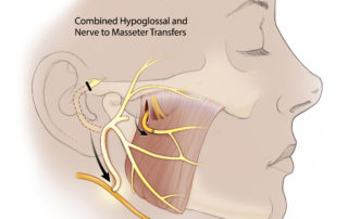 Combined masseteric nerve and hypoglossal nerve transfers for facial reanimation: the end-to-side facial-to-hypoglossal nerve transfer may be combined with a selective nerve to masseter transfer in a single operation, thereby restoring facial tone (via hypoglossal nerve) and smile (via nerve to masseter).