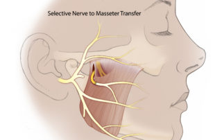 Selective masseteric nerve transfer: the nerve to masseter may be used in selective fashion to resupply only a paralyzed buccal branch of the facial nerve for smile reanimation. This may be useful in cases where additional regeneration through the other branches of the facial nerve is expected. Alternatively, this is useful in combination with a hypoglossal nerve transfer.