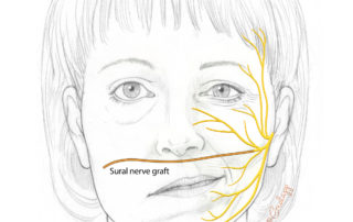 For some cases of chronic facial paralysis, a long nerve graft may be harvested from the leg (not shown) and connected to a donor nerve branch on the nonparalyzed side of the face. The graft is then tunneled underneath the skin to the contralateral side. At a second surgery, this nerve graft may be connected to the gracilis muscle transplanted from the inner thigh region in order to reestablish movement of the corner of the mouth.