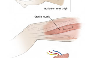 Gracilis muscle harvest: the gracilis muscle free tissue transfer is harvested from the inner thigh region, with its accompanying nerve, artery, and vein. This muscle can then be transplanted to the paralyzed side of the face in order to reestablish movement of the corner of the mouth (smile).