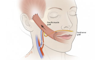 Gracilis free tissue transfer for facial paralysis: the gracilis muscle free tissue transfer is connected to a new nerve and vascular supply in the face, to permit movement of the paralyzed side of the face. The gracilis muscle may be “powered” by the contralateral side of the face via a long graft, or by the nerve to masseter on the ipsilateral side (not shown).