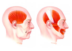 In long-standing facial paralysis which is not suitable for a reinnervation procedure, a strip of temporalis muscle can be used to elevate the corner of the mouth. This so-called dynamic sling permits some degree of volitional elevation of the corner of the mouth. Two incisions (dashed lines) are required: preauricular–temporal and oral commissure. The muscle strip is tunneled under the cheek and then split before attachment to the musculofascial plane of the upper and lower lips. Overcorrection is wise, as some loosening inevitably occurs in the early postoperative period. A cosmetic donor deformity results from the decrease in temporal bulk coupled with a bulge over the zygomatic arch due to the folded muscle pedicle. This hollowed temple appearance can be compensated for by placement of a prosthetic disc (e.g., Silastic) in the temporal fossa or with fat grafting.