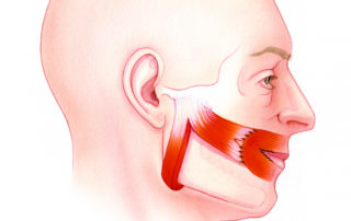 A limited reanimation of the oral commissure can also be accomplished by its suspension with the anterior fibers of the masseter muscle. This technique is carried out via an intraoral approach.