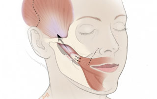 Temporalis tendon transfer: the insertion of the temporalis tendon is identified at the medial aspect of the coronoid process of the mandible. An osteotomy is made to divide the coronoid with its fibrous attachments from the temporalis muscle and its associated tendon. This tendon–muscle complex is then advanced to the oral commissure for resuspension. Undue tension should be avoided, and this can be facilitated by release of the temporalis muscle from its fossa followed by resuspension with the correct length–tension relationship.